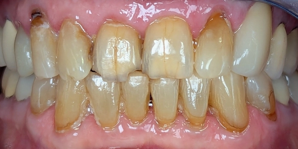 Before dental crowns